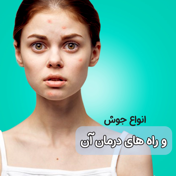 انواع جوش صورت، علائم و درمان